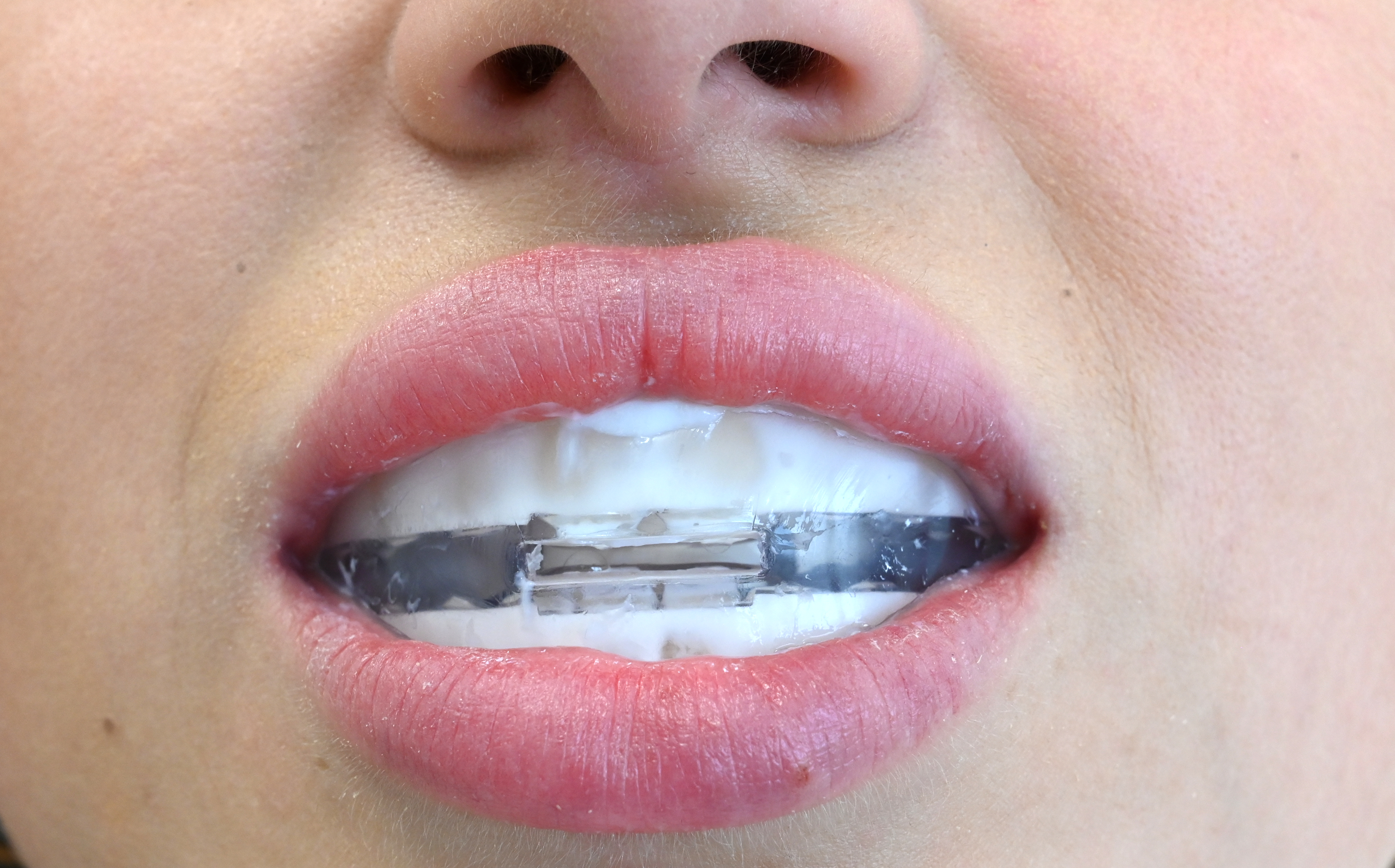 ApaCare Repair Zahnschiene 2-teilig